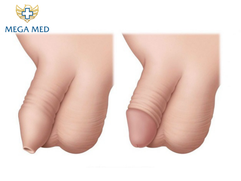 Hiện tượng dài bao quy đầu